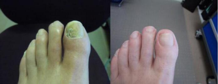 Fotografii ale picioarelor înainte și după utilizarea cremei Zenidol