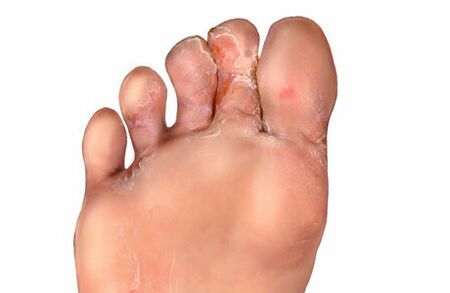 simptome ciupercii degetelor de la picioare