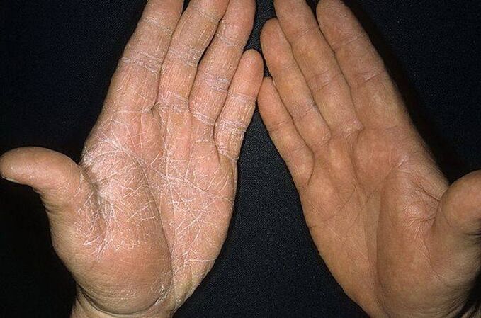 simptome ale unei ciuperci pe pielea mâinilor