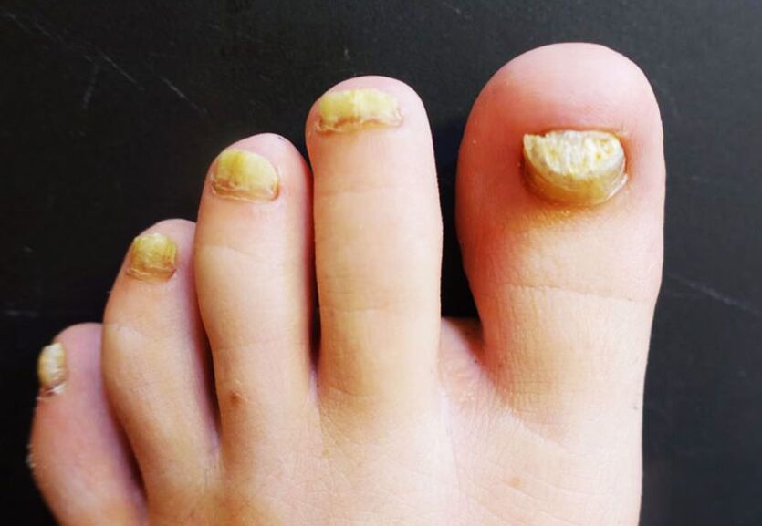Aspect inestetic al unghiilor de la picioare afectate de ciuperca
