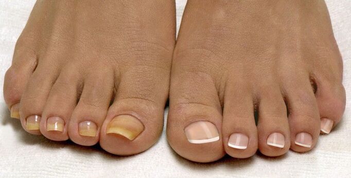 Ciuperca unghiilor de la picioare pe un picior