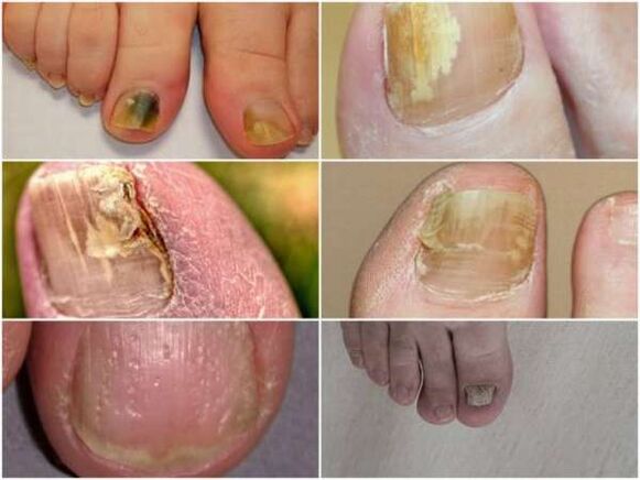 semne de ciuperca unghiilor de la picioare
