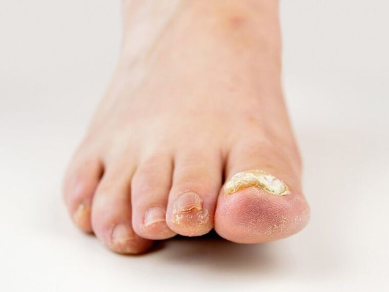 unghiile de la picioare afectate de ciuperci