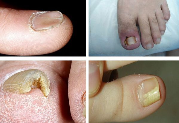 Simptome de onicomicoză pe picioare