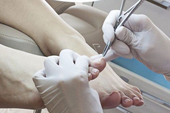 Îndepărtarea mecanică a unghiilor de la picioare afectate de ciuperci