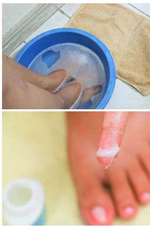 utilizarea uleiurilor naturale în tratamentul ciupercii unghiilor de la picioare
