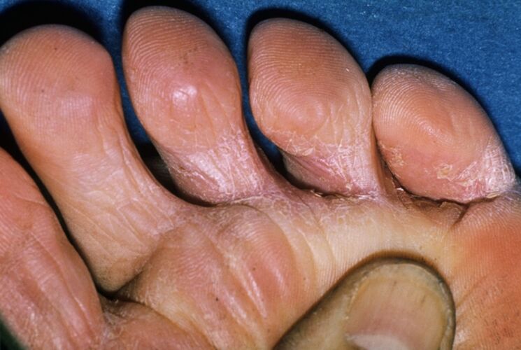 ciuperca pe degetele de la picioare