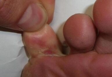 o fisură în deget de la picior este rezultatul unei infecții cu ciuperci